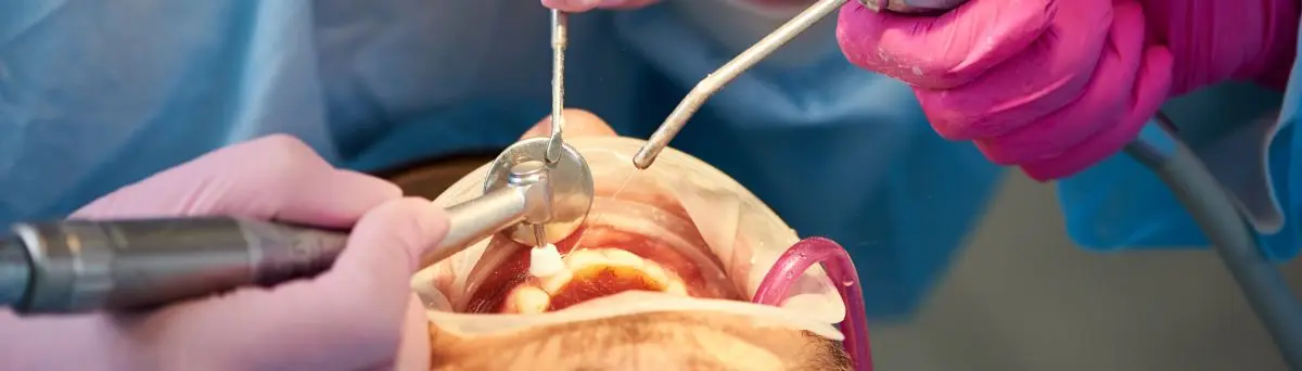 Clínica de odontología para exodoncia en Villavicencio