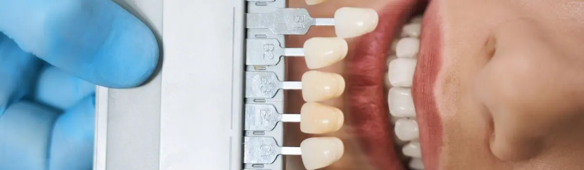 Diseño de sonrisa con blanqueamiento dental en Barzal Villavicencio