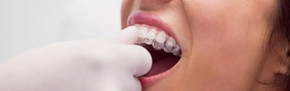 Rehabilitación oral con placas anti bruxismo en Villavicencio